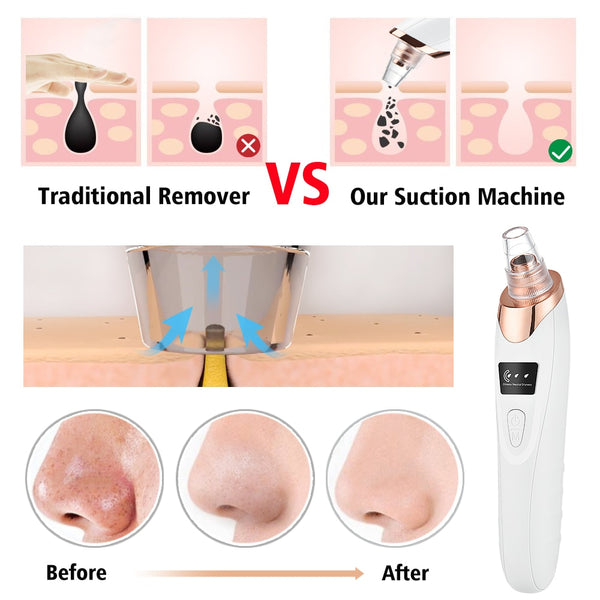 Blackhead Remover Vacuum Acne Pimple Black Spot Suction Electric Facial Pore Cleaner Skincare Exfoliating Beauty Instrument